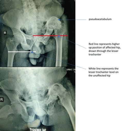 Pelvis AP And Frog Leg Lateral Views Depicting A Neglected Posterior