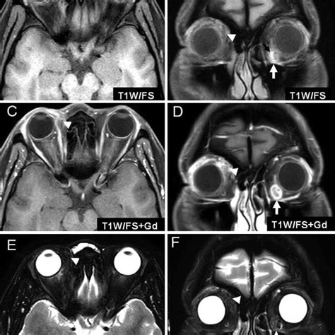 Photograph Of The Right Thrombosed Orbital Varix Removal During The