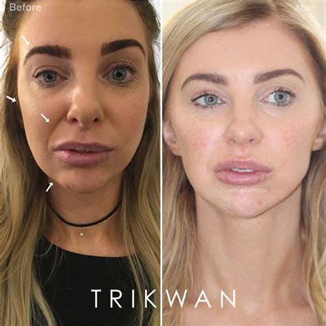 Dermal Filler Trikwan Aesthetics Treatment For Jowls London