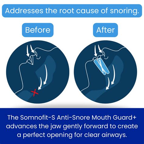 Somnofit-S Anti-Snore Mouth Guard+ – SnoreLessNow