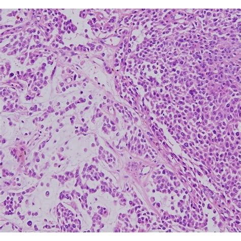 Histopathological Examination Of Nasolabially Excised Mass Tumor Had A