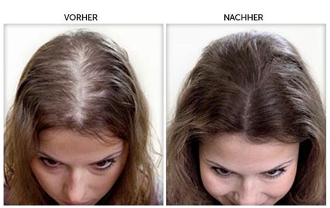 Hairvox Vorher Nachher Erblich Bedingter Haarausfall Haare Vorher