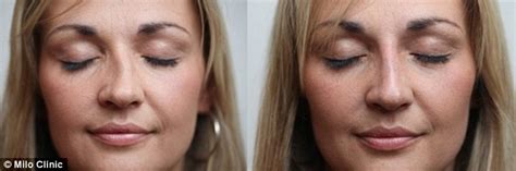 The No Knife Nose Job The Revolutionary Procedure That Smooths Out