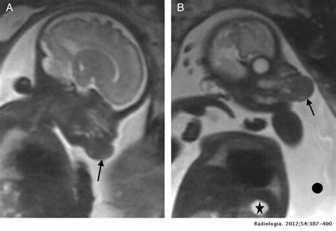 Utilidad De La Resonancia Magnética En El Estudio Prenatal De Las