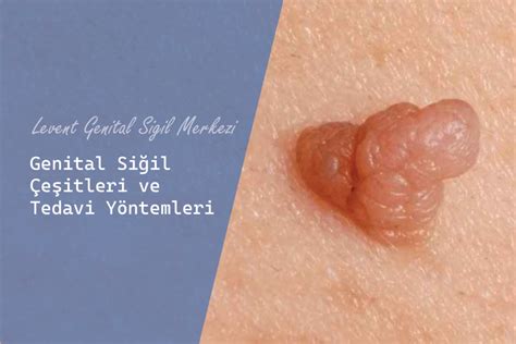 Genital Siğil Çeşitleri ve Tedavi Yöntemleri Genital Siğil