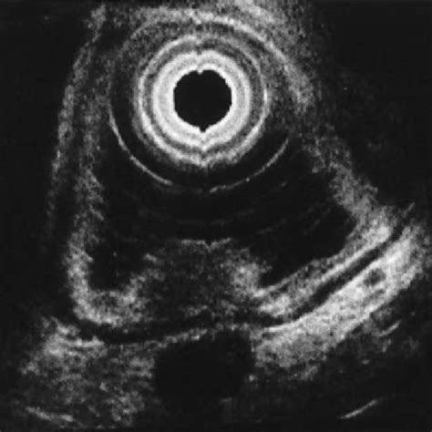 Endoscopic Ultrasound EUS Finding Demonstrating That The Tumor Has