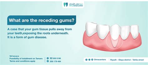 What You Need To Know About The Causes Of Receding Gums And Treatment