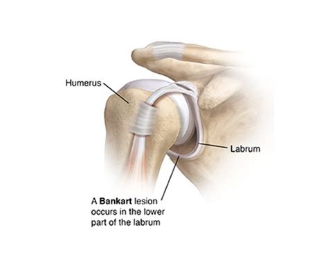 Shoulder Bankart Lesion Treatment Kingston, Surrey UK | Physio & More