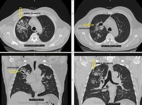 Tbc Pulmonar Diagnostico Org