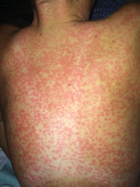 Amoxicillin Rash Adult