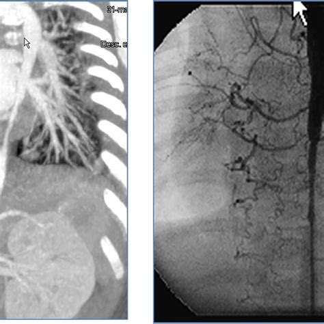 Ct Scan And Angiography Showed A Tight Low Thoracic And Abdominal Download Scientific Diagram