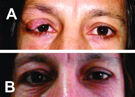 Left Preoperative Bulging Orbital Reborda And Mechanical Ptosis Caused