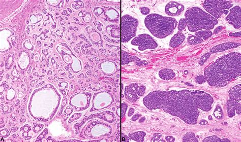 Pattern Based Grading In Adenoid Cystic Carcinoma A Tubular And