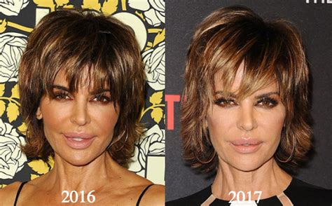 Lisa Rinna Plastic Surgery Before And After Photos Latest Plastic