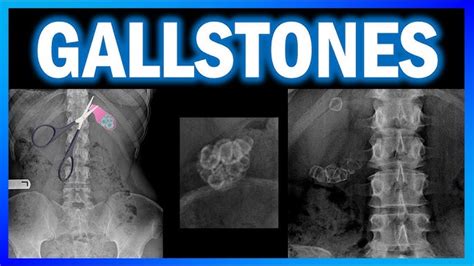 Gallbladder Stones Xray