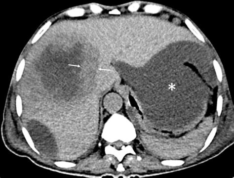 Ct Of Amebic Liver Abscess Different Morphological Types With Different Clinical Features Pmc