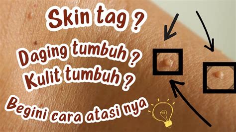 Cara Menghilangkan Daging Tumbuh Atau Skin Tag Secara Alami Tanpa