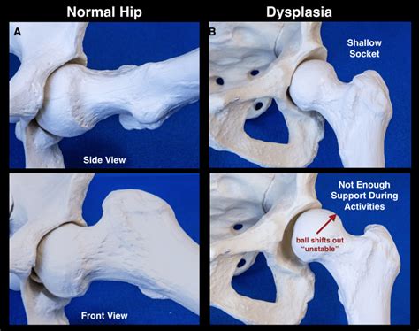 normal hip xray pathologic fracture hip xray getyourasse
