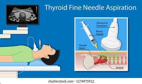 Thyroid Cancer Disease Nodules Ultrasound Screening Stock Vector ...