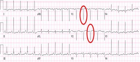 Septal Infarct