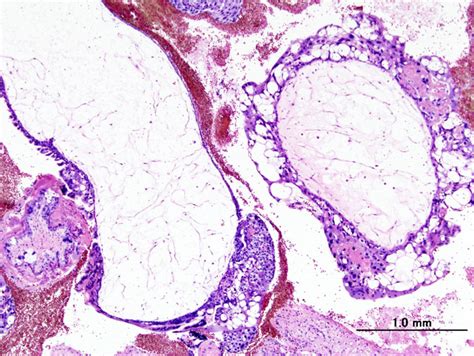 Molar Pregnancy Hydatidiform Moles And Choriocarcinoma Lecturio