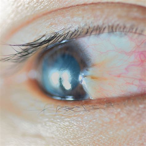 What Causes a Bump on the Eyeball?