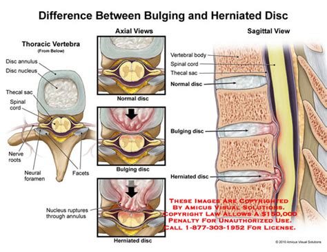 Bulging Disc Vs Herniated Disc Whats The Difference