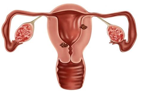 A New Test for Endometrial Cancer? - Endometrial Cancer in Focus