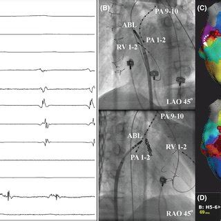 Intracardiac Ecg Fluoroscopic Image And D Mapping Of Svt A The