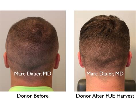 Fue Patient Video Testimonial Marc Dauer Md Hair Transplant Doctor