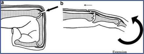 Hand Injuries Boxer Fractures And Fight Bites The Journal For Nurse