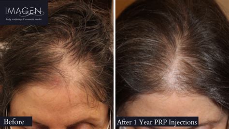 Platelet Rich Plasma Prp — Rejuvenation For Skin Hair And Sex