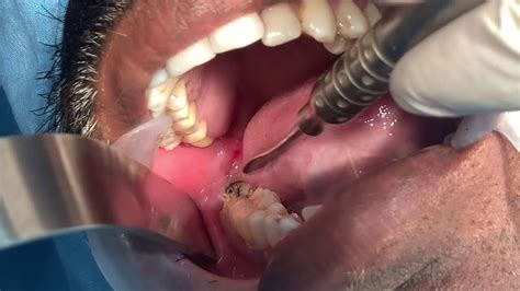 Mesioangular Impacted Wisdom Tooth Removal Third Molar Extraction