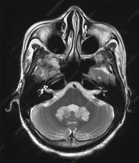 Cryptococcal Meningitis In Aids Stock Image C0271563 Science