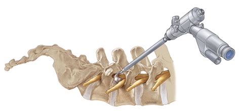 Minimally Invasive Spine (MIS) or Endoscopic Spine Surgery | Joint ...