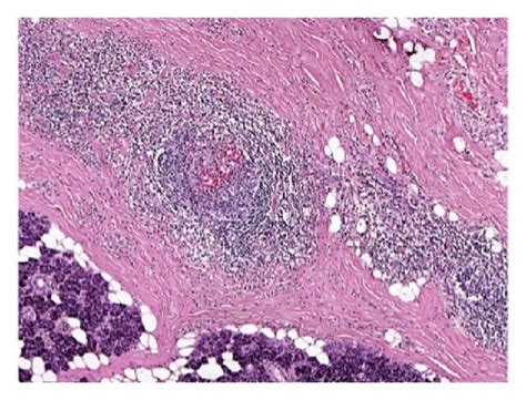 A Diffuse Chronic Inflammatory Cell Infiltrate With Germinal Center