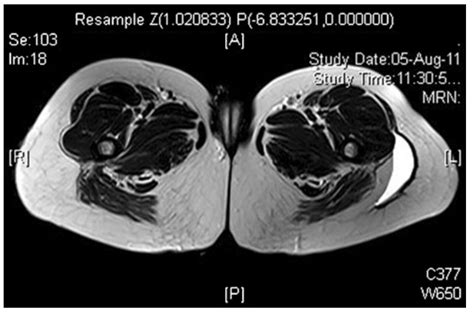 Morel-Lavallee lesions - Sports Medicine Review