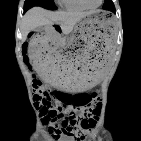 Plain Abdominal Computed Tomography Shows Gastric Distension And