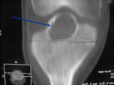 Chondroblastoma Bone Tumors Tumors Of The Bone