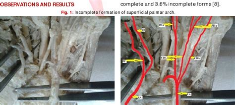 Figure From An Anatomical Study Of Superficial Palmar Arch Semantic