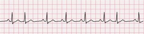 ECG Lead II Interpretation, Two Day Course Edmonton AB Oct 26&27 ...