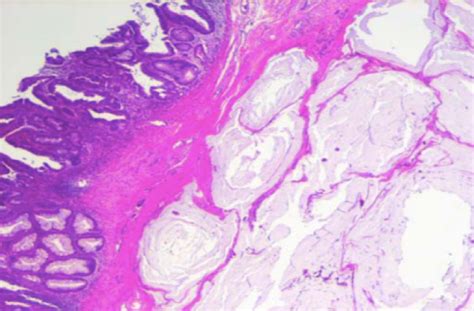 Understanding Mucin Pool Formation After Chemoradiotherapy By Ian