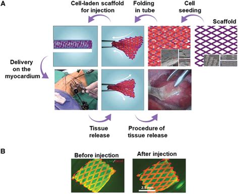 Shapememory Scaffolds For Minimally Invasive Delivery Of Cardiac