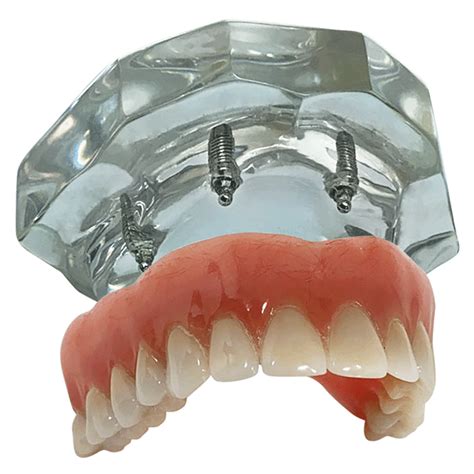 Macro Modelo Overdenture em Acrílico 4 implantes Oring Prótese