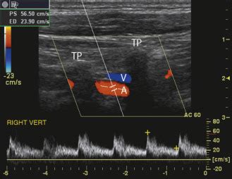 Ultrasound Assessment Of The Vertebral Arteries Radiology Key