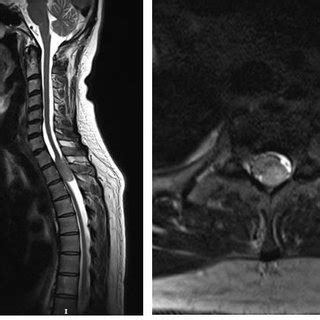 Immediate Post-operative MRI image shows Pseudo meningocele with cord ...