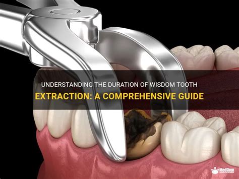 Understanding The Duration Of Wisdom Tooth Extraction A Comprehensive