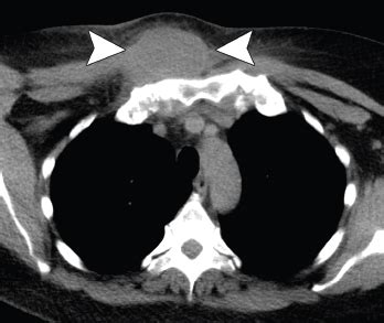 Case Report Abscess As A Manifestation Of Autoinflammatory Disease