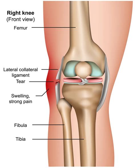 Causes Prevention Of Knee Ligament Injuries ACL PCL MCL 47 OFF