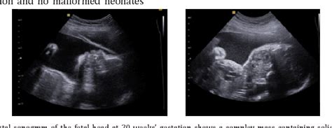 Figure 1 From Fetal Nasopharyngeal Teratoma An Autopsy Case Report